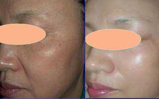 RF-лифтинг лица – что это такое?