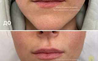 Фото до и после увеличения губ гиалуроновой кислотой 1 мл