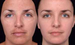 Чистка лица у косметолога – фото до и после