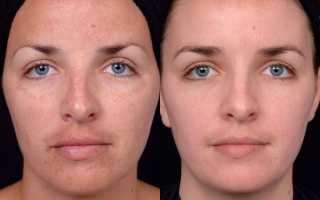 Чистка лица у косметолога – фото до и после