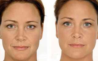 Отзывы на биоревитализацию Ялупро (Jalupro) с фото до и после