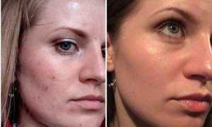 Пилинг PRX T33 – отзывы с официального сайта с фото до и после