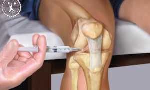 Уколы в коленный сустав при артрозе – препараты