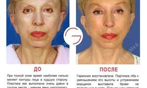 Упражнения для подтяжки лица: коррекция овала без операций