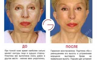 Упражнения для подтяжки лица: коррекция овала без операций