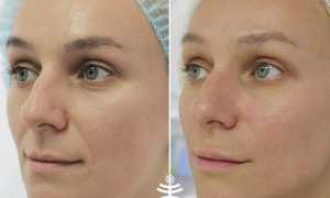 Биоревитализация лица – отзывы с фото до и после и последствия