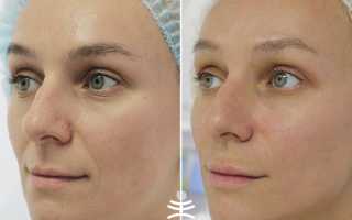Биоревитализация лица – отзывы с фото до и после и последствия