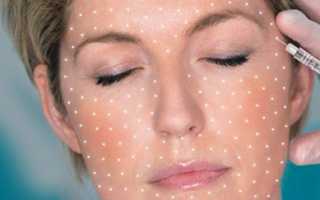 Биоревитализация лица – что это такое, что дает и какие имеет плюсы и минусы?