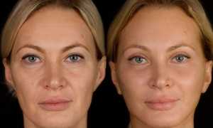 Аппаратный СМАС-лифтинг – отзывы на подтяжку лица с фото!