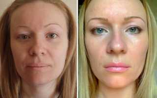 Ультразвуковая подтяжка лица SMAS-лифтинг – отзывы с фото до и после