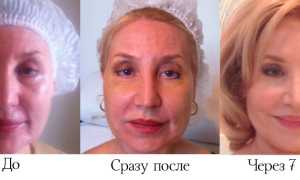 Круговая подтяжка лица – фото до и после, цены и особенности процедуры