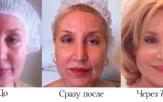Круговая подтяжка лица – фото до и после, цены и особенности процедуры