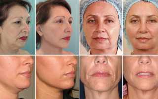 Нитевой лифтинг лица после 50 лет – отзывы с фото до и после