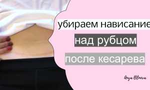 Как убрать живот после кесарева сечения?
