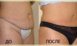 Как похудеть после кесарева и убрать живот. Эффективные упражнения