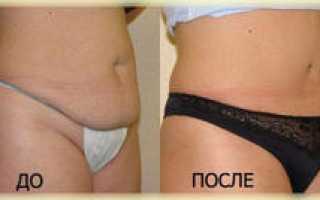 Как похудеть после кесарева и убрать живот. Эффективные упражнения