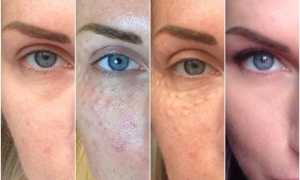 Отзывы на биоревитализацию Аквашайн косметологов и клиентов