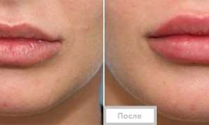 Биоревитализация гиалуроновой кислотой – отзывы с фото до и после, цены и всё о процедуре!