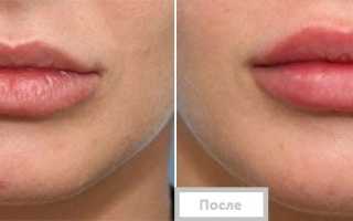 Биоревитализация гиалуроновой кислотой – отзывы с фото до и после, цены и всё о процедуре!