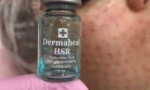 Отзывы на биоревитализацию Дермахил HSR косметологов и пациентов