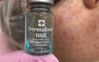 Отзывы на биоревитализацию Дермахил HSR косметологов и пациентов
