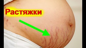 Как бороться с растяжками