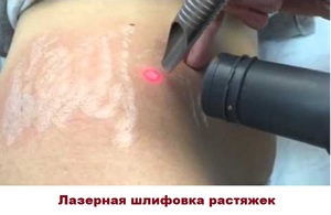 Лазерная шлифовка: как убрать растяжки