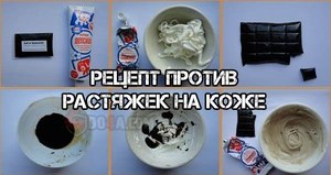 Как лечить растяжки