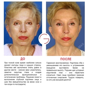 Подтянула кожу лица