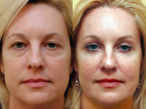 Лазерная биоревитализация – фото до и после