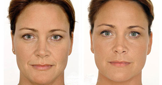 Фото до и после биоревитализации Ялупро