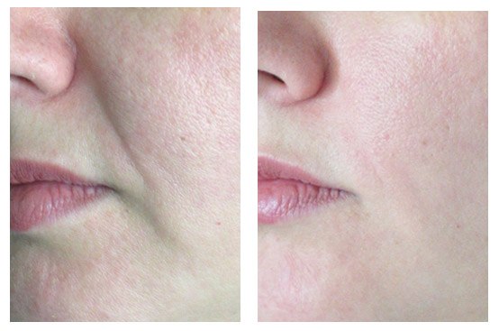 Носогубные складки