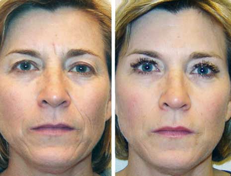 Межбровные морщины