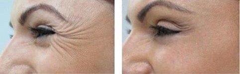 Гусиные лапки