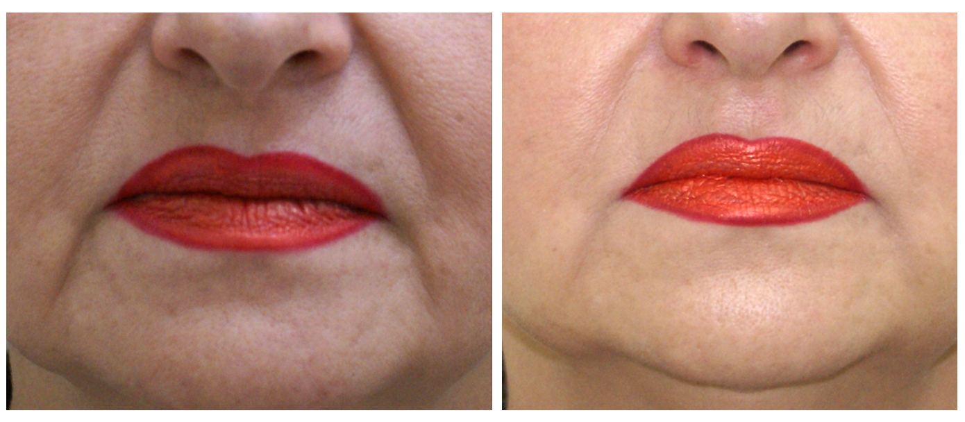 Морщины в уголках рта