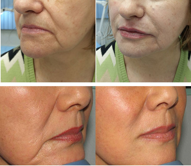 Марионеточные морщины