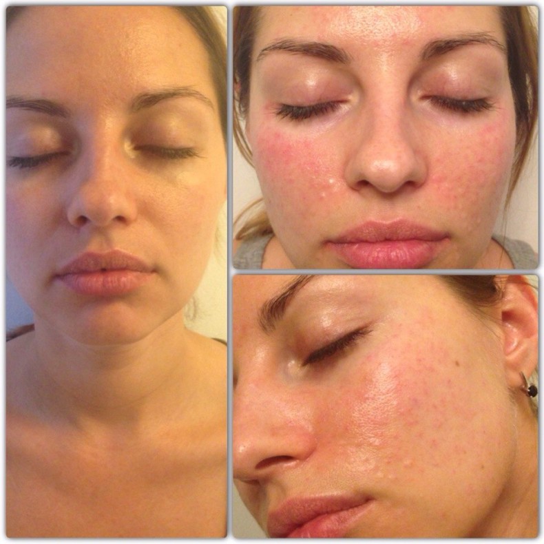 Отзывы о биоревитализации гиалуроновой кислотой с фото до и после