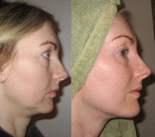 Отзывы о биоревитализации гиалуроновой кислотой с фото до и после