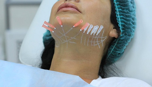 Техника проведения круговой подтяжки нитями