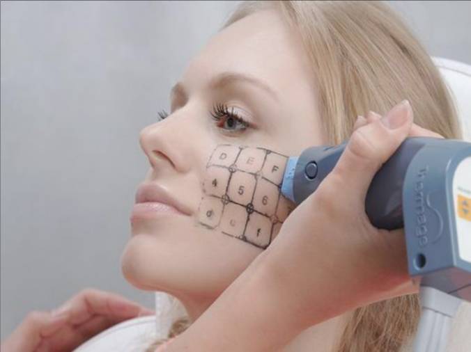 Подтяжка радиоволнами без операции