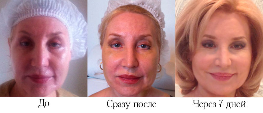 После применения нитей для лифтинга