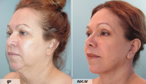 Фото до и после нитей Аптос Фото до и после нитей Аптос