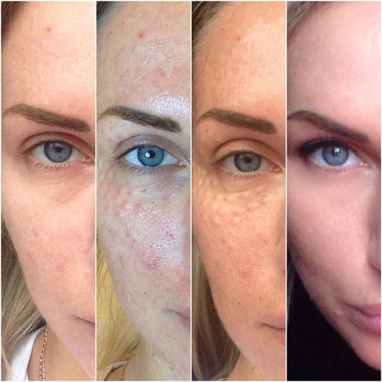 Отзывы о биоревитализации Аквашайн клиентов