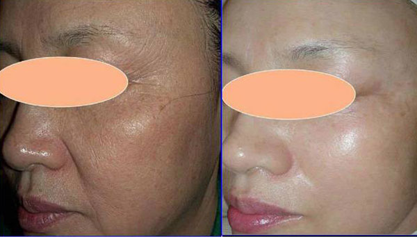 Фото до и после РФ-лифтинга Фото до и после РФ-лифтинга