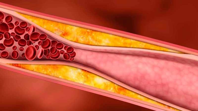 Гипертония что это