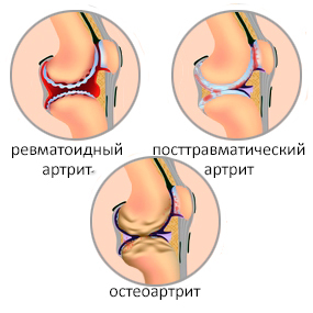 Артрит коленного сустава