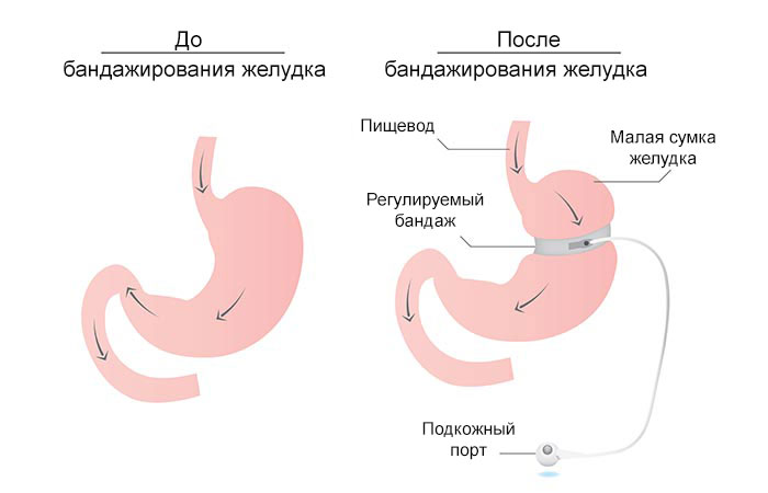 Бандажирование желудка