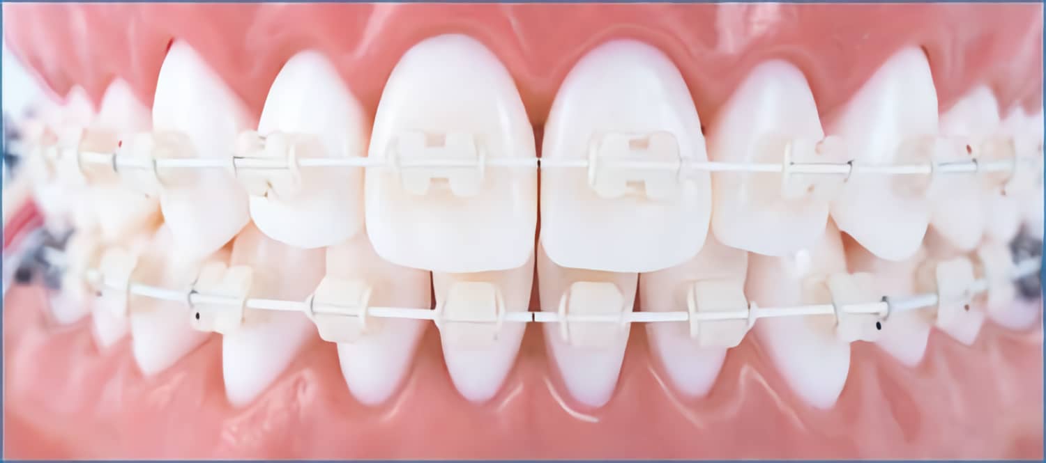 Исправление прикуса