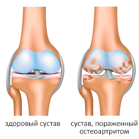 остеоартроз коленного сустава