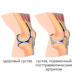 Посттравматический артрит